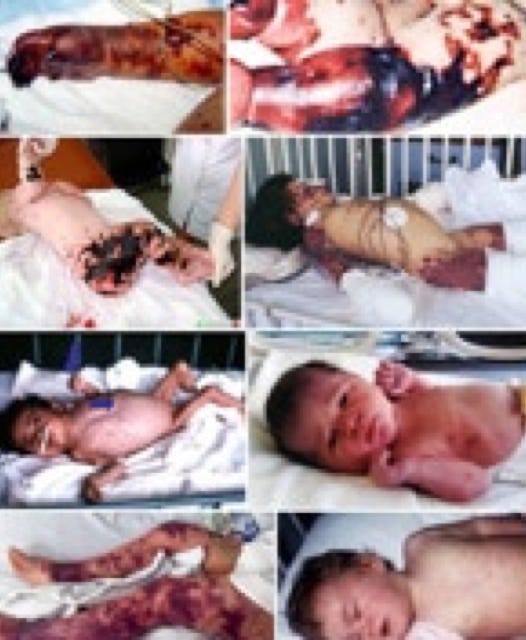 Neiseiria Meningitis